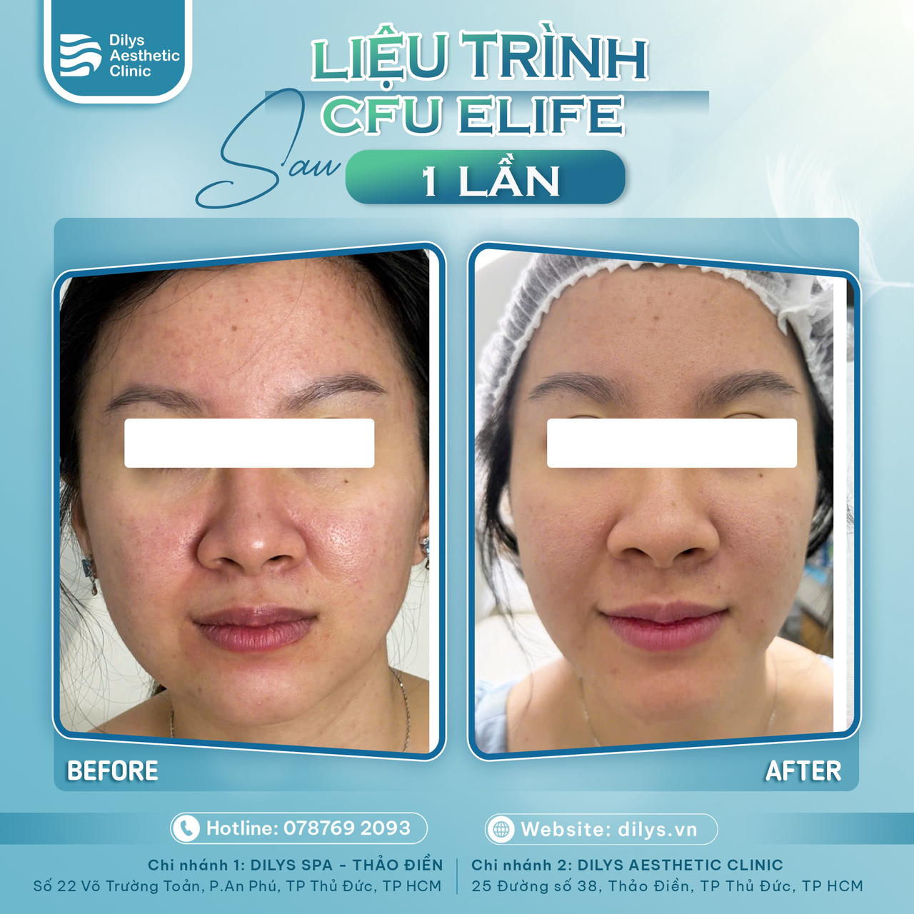 làm thon gọn mặt bằng CFU Elife