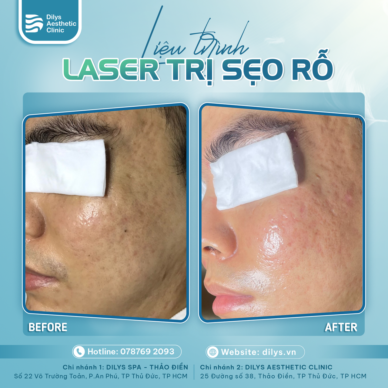 Liệu trình laser điều trị sẹo rỗ