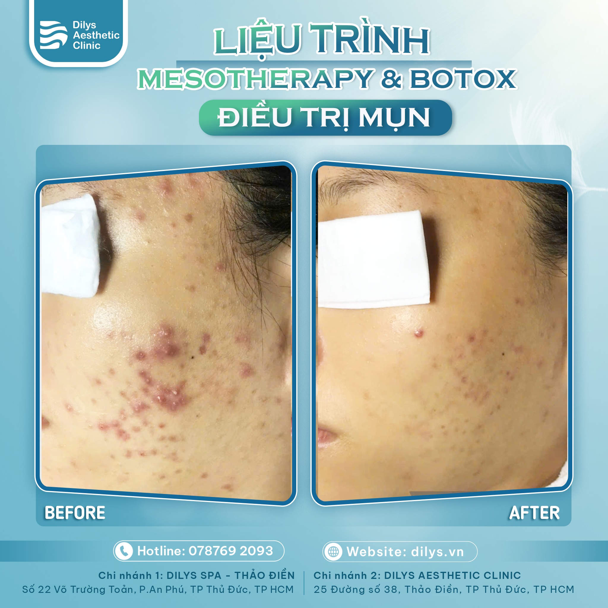 HÀNH TRÌNH KHÁCH HÀNG ĐIỀU TRỊ MỤN TẠI PHÒNG KHÁM DILYS_Case 1_Điều trị mụn