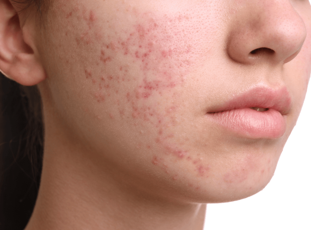 Điều trị da cá nhân hóa – Làm chủ làn da khỏe mạnh từ gốc tại Dilys Aesthetic Clinic