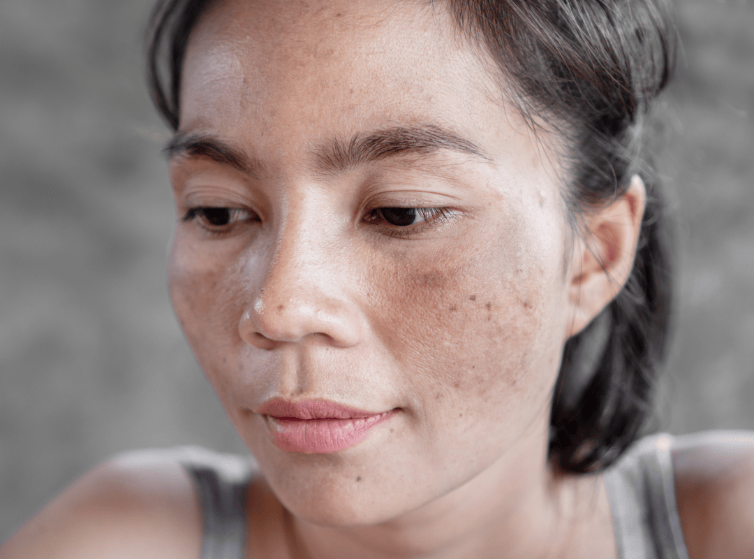 Điều trị da cá nhân hóa – Làm chủ làn da khỏe mạnh từ gốc tại Dilys Aesthetic Clinic