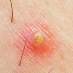 Triệt Lông Không Chỉ Là Làm Mịn – Mà Là Làm Đẹp Da Từ Gốc Tại Dilys Aesthetic Clinic