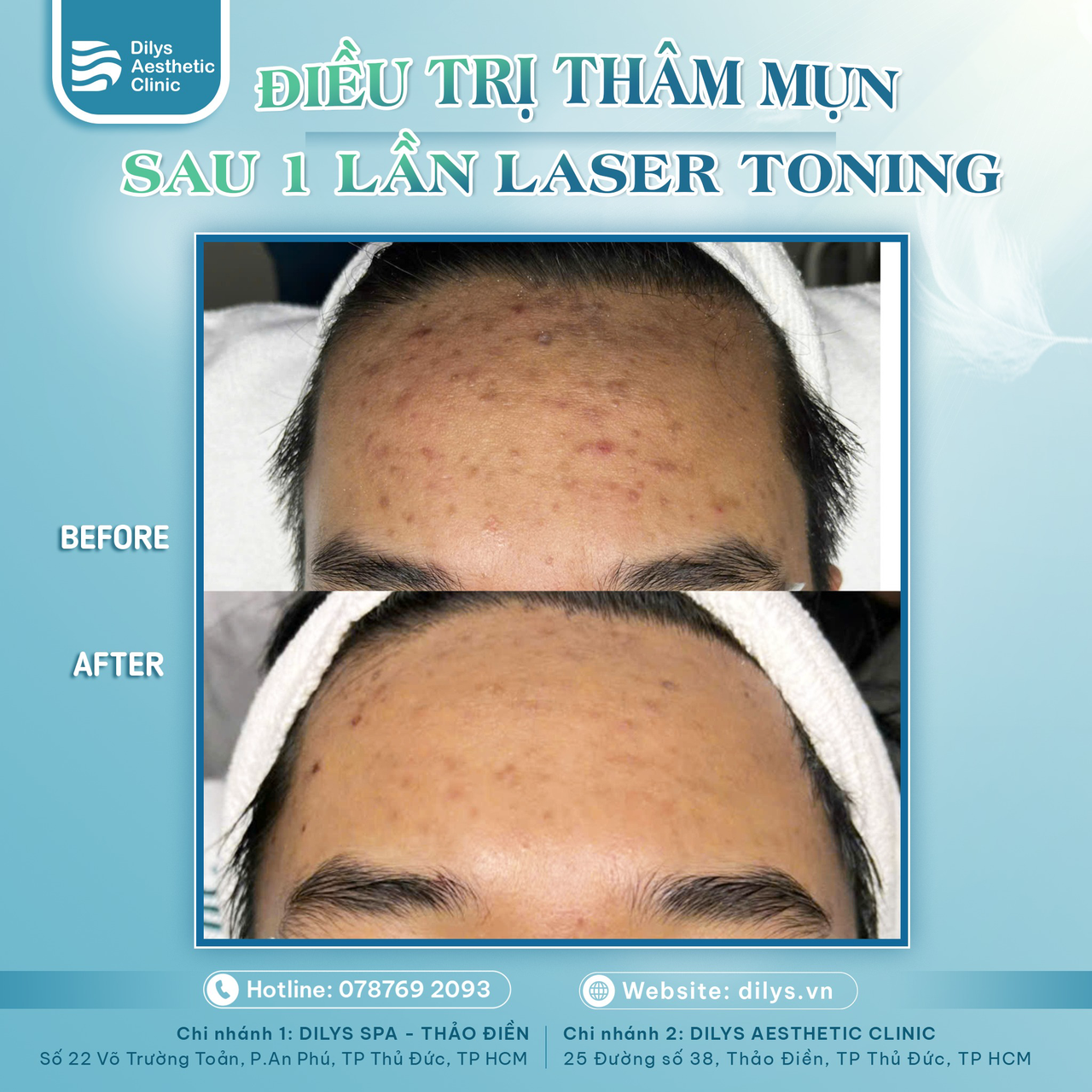Điều trị thâm mụn bằng laser toning
