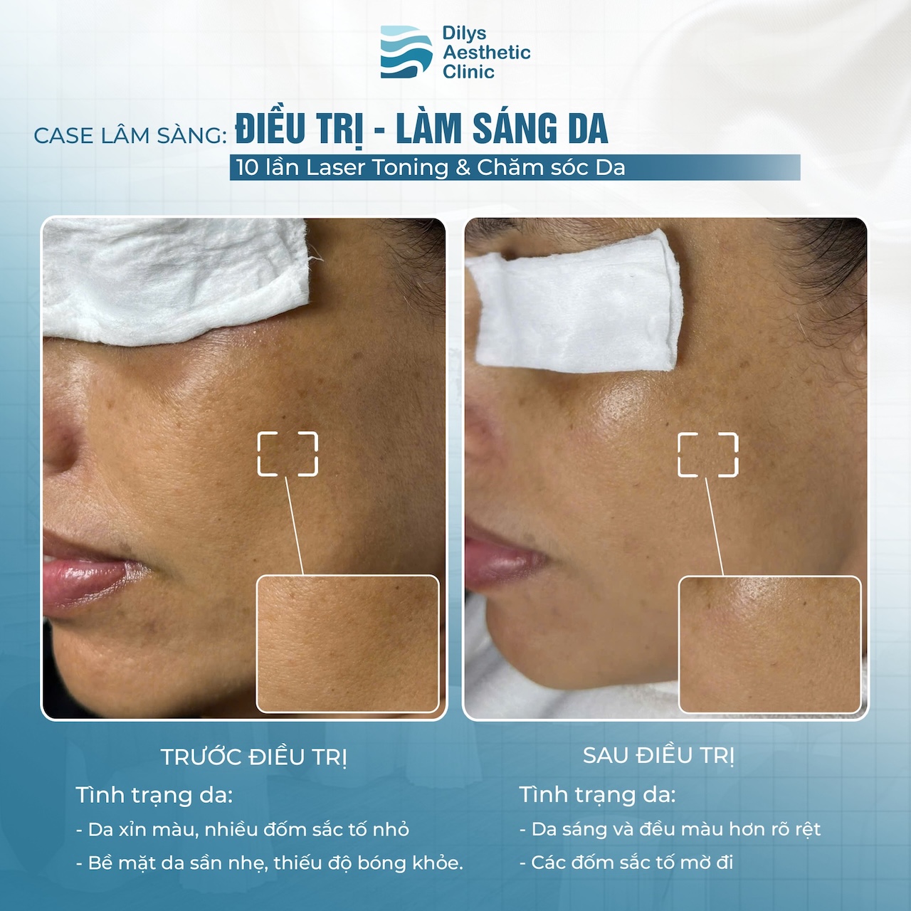 Kết quả trước và sau 10 buổi Laser Toning làm sáng da tại Dilys Aesthetic Clinic.