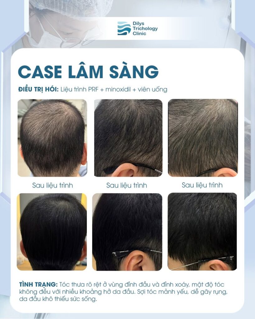 case-lam-sang-dieu-tri-hoi-dau-nam-gioi-tai-dilys