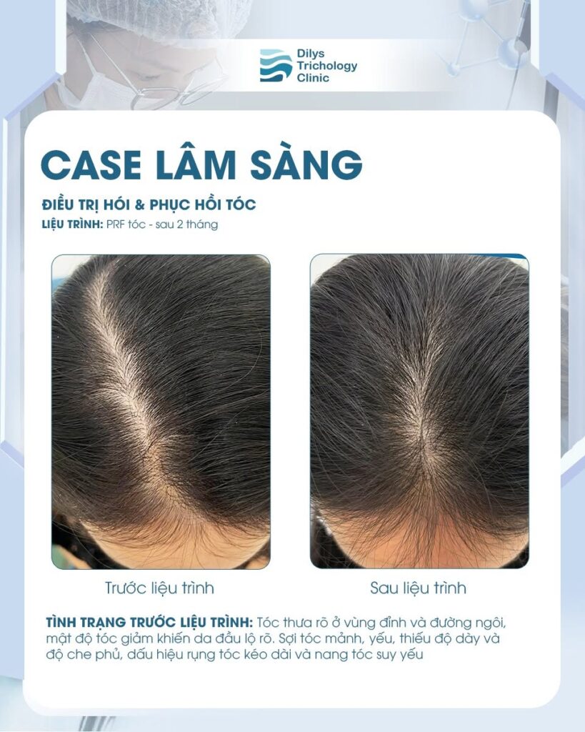 phuc-hoi-toc-thua-dinh-dau-cho-nu-gioi-bang-prf