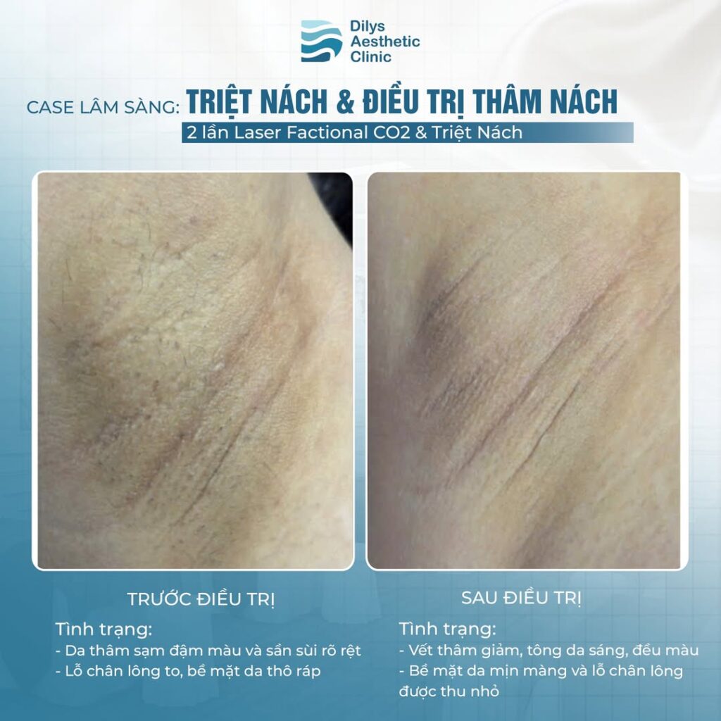 Case lâm sàng trước và sau điều trị kết hợp Laser Fractional CO2 và triệt lông nách bằng Diode Laser tại Dilys, cho vùng nách thâm sạm nặng được cải thiện rõ rệt.